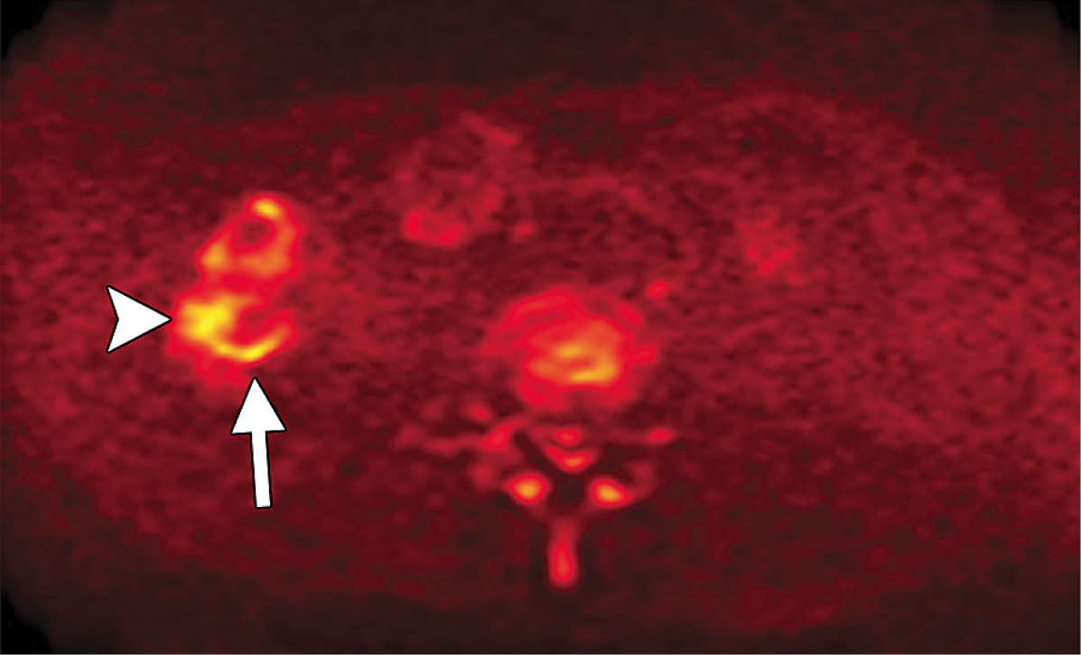 Crohn disease Axial color-coded diffusion-weighted MR image